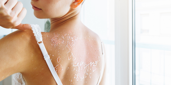 Understanding Sunburn - More than just red skin